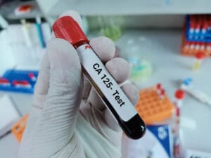 CA 125 Test Results